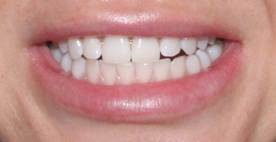 Диета После Отбеливания Зубов Zoom 4